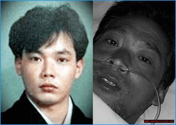 Understanding Hisashi Ouchi Skin: A Deep Dive Into Radiation Effects